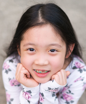 early orthodontic treatment