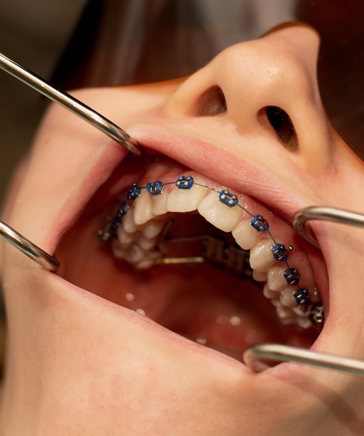 expander