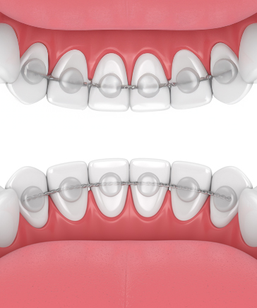 retainers